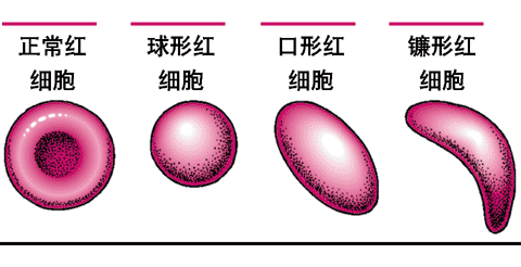 镰状细胞贫血