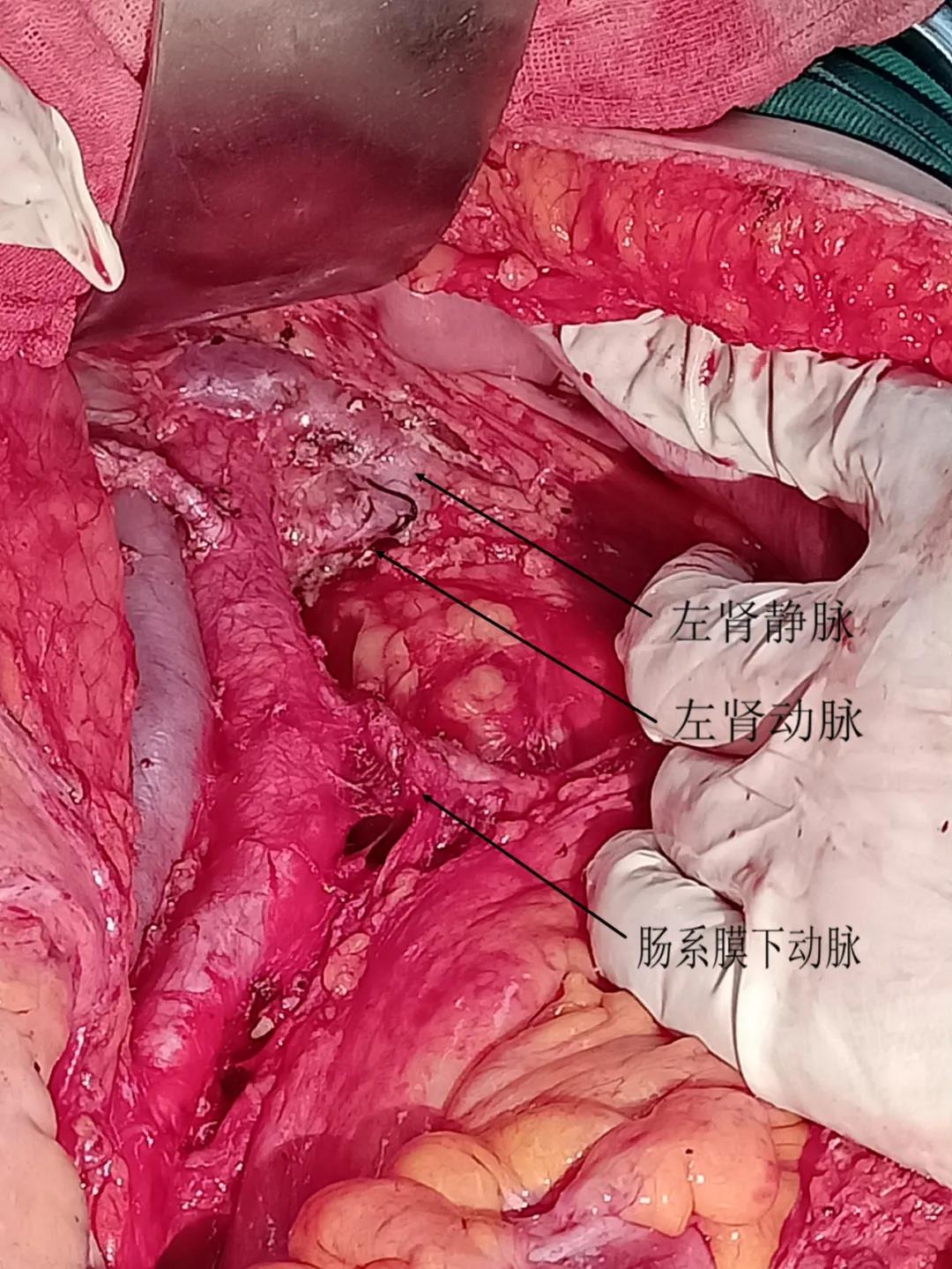 肾部分切除术英文图片