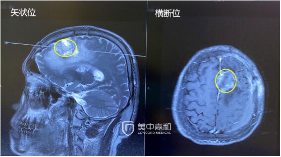 患了“终结者”癌，术后如何防“反扑”？