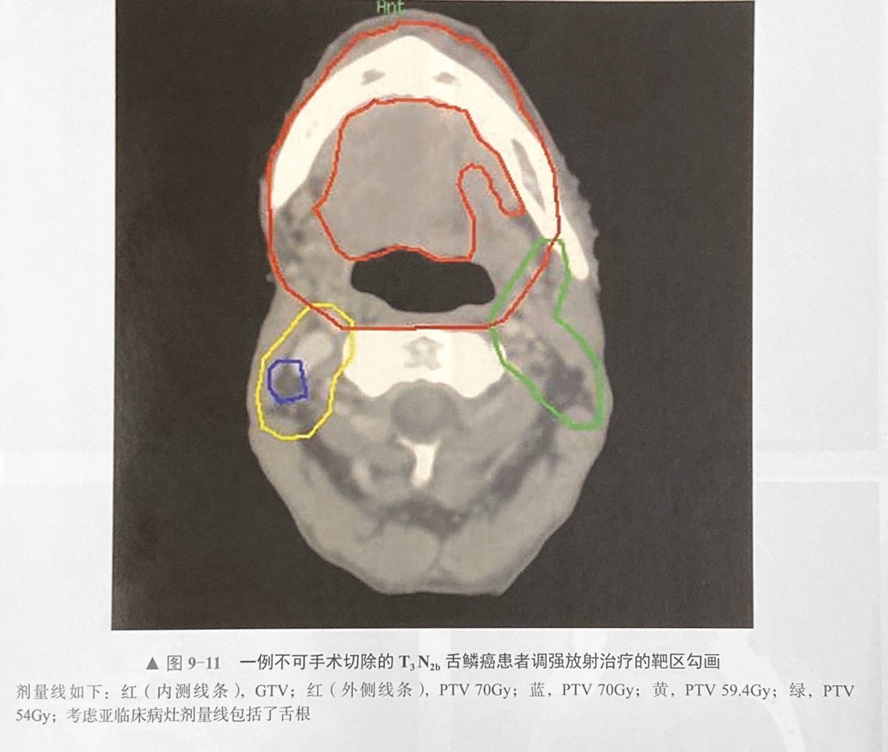 放射治疗技术发展史