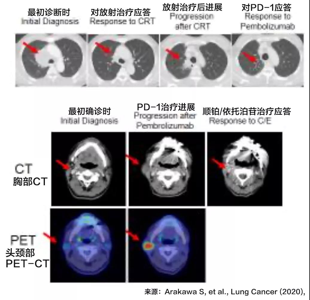 PD-1治疗的继发性耐药原来是因为它突变了