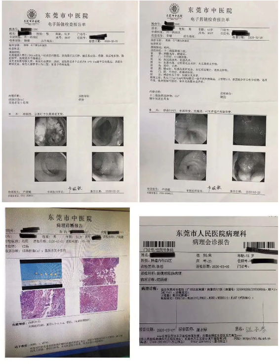 (距离肛门60cm)直肠多发小息肉.病理提示(结肠)符合低分化腺癌.