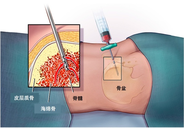 骨髓活检
