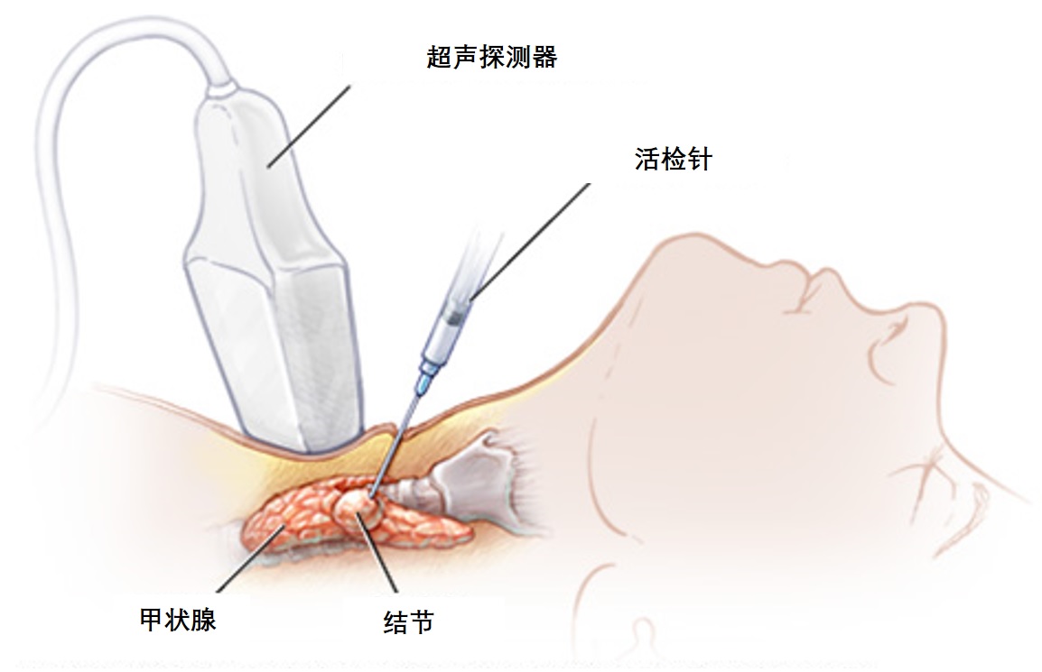 甲状腺活检