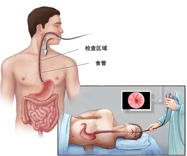 内镜活检