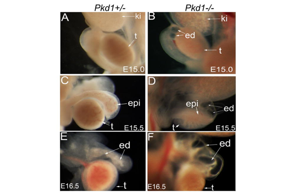 PKD1基因缺陷