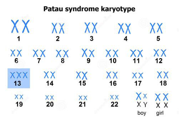 帕陶综合症（13-三体综合症）