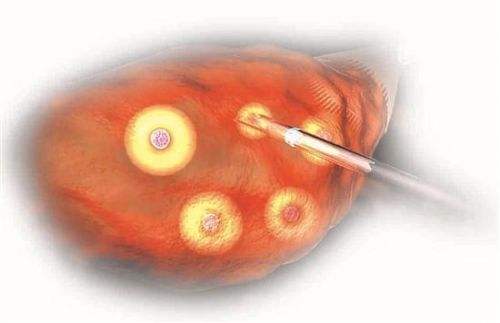 试管婴儿取卵的步骤