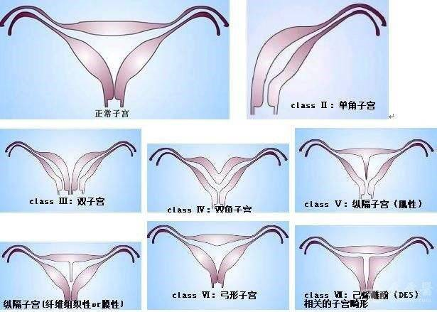 子宫畸形图片分类图片